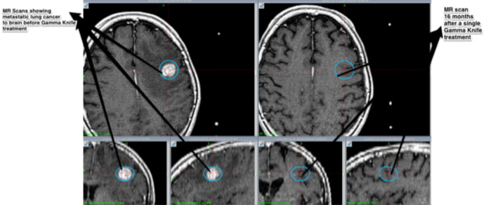 metastatic-brain-tumors_orig
